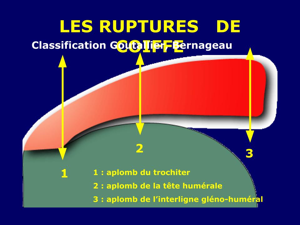 Les lésions de la coiffe des rotateurs. – Imagerie de l'appareil ...