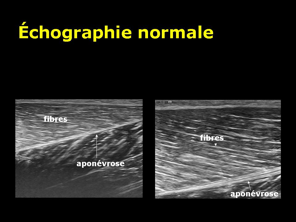 Les lésions musculaires traumatiques : généralités. – Imagerie de ...