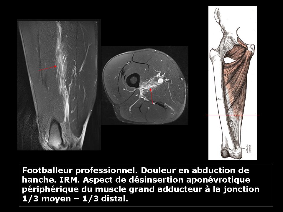 Les « déchirures » des adducteurs. – Imagerie de l'appareil locomoteur