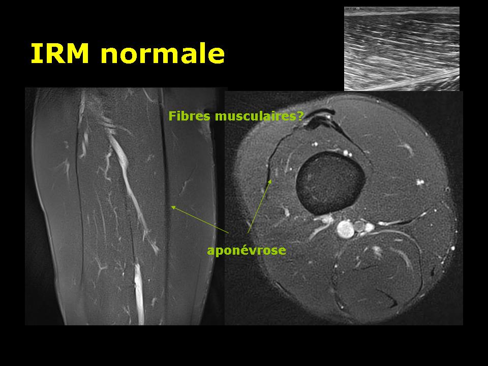 Les lésions musculaires traumatiques : généralités. – Imagerie de ...