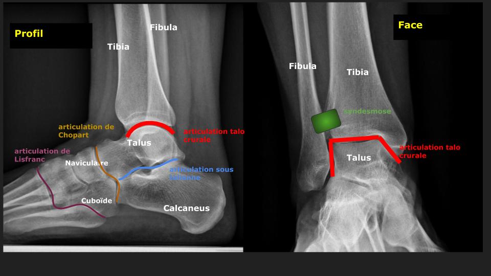Imagerie des entorses de cheville. – Imagerie de l'appareil locomoteur