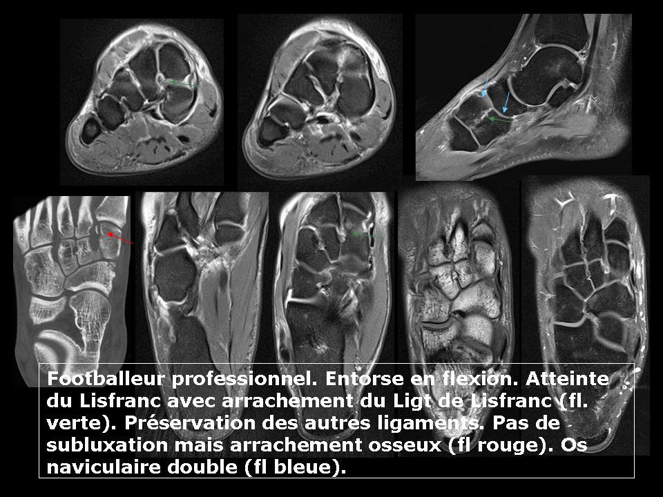 Imagerie des entorses de cheville. – Imagerie de l'appareil locomoteur