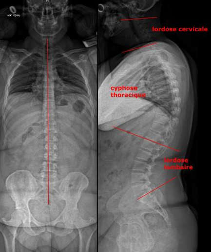 Radiographie de face et profil du rachis total (technique EOS).