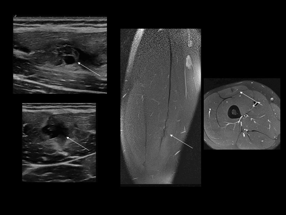 Les « déchirures » du quadriceps. – Imagerie de l'appareil locomoteur