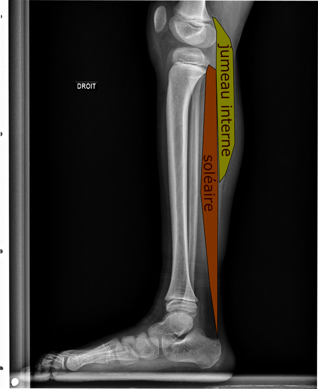 Les « déchirures » des muscles du mollet. – Imagerie de l'appareil ...