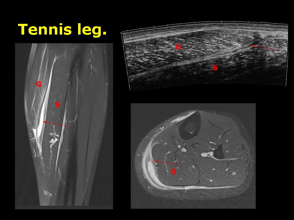 Les « déchirures » des muscles du mollet. – Imagerie de l'appareil ...